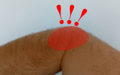 All about…Tennis Elbow